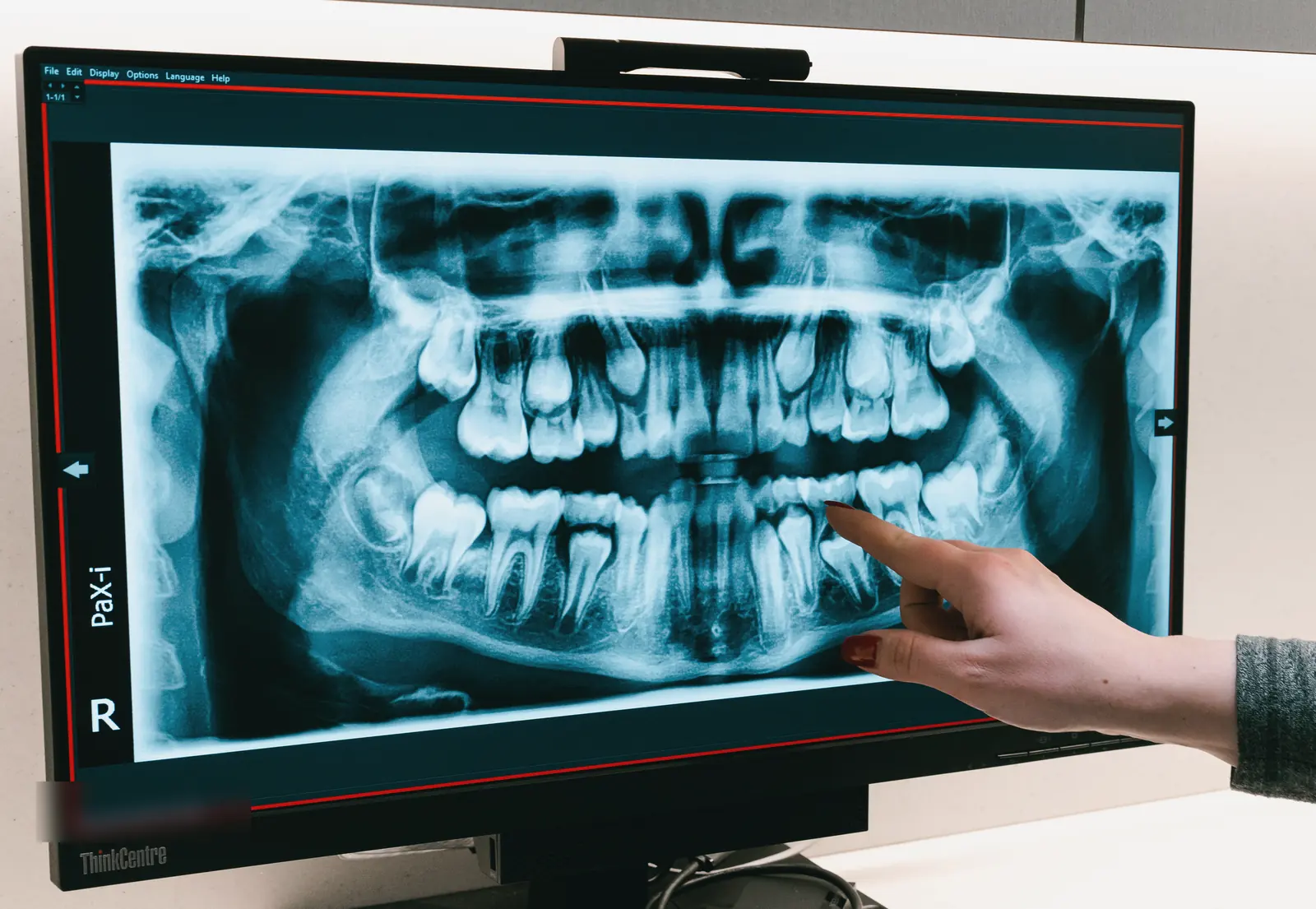 Dr. Kat pointing to a tooth on a panoramic X-ray